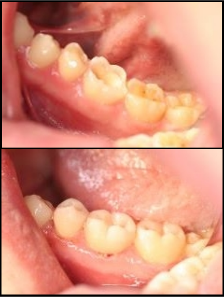 Dental Erosion And Wear | Before And Afters | BelleDental