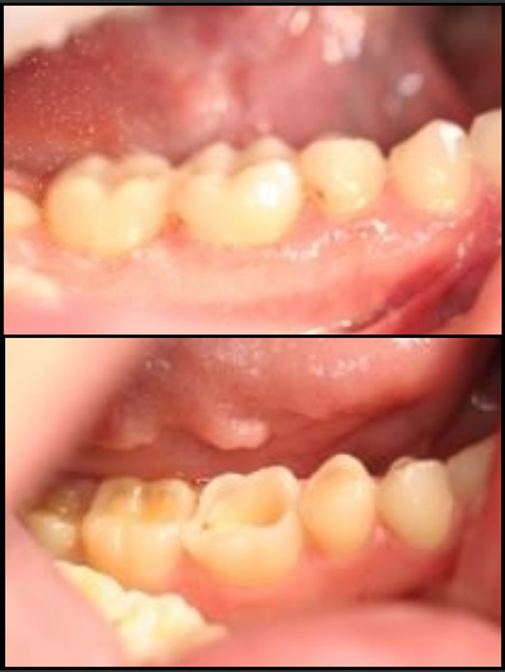 Dental Erosion And Wear | Before And Afters | BelleDental