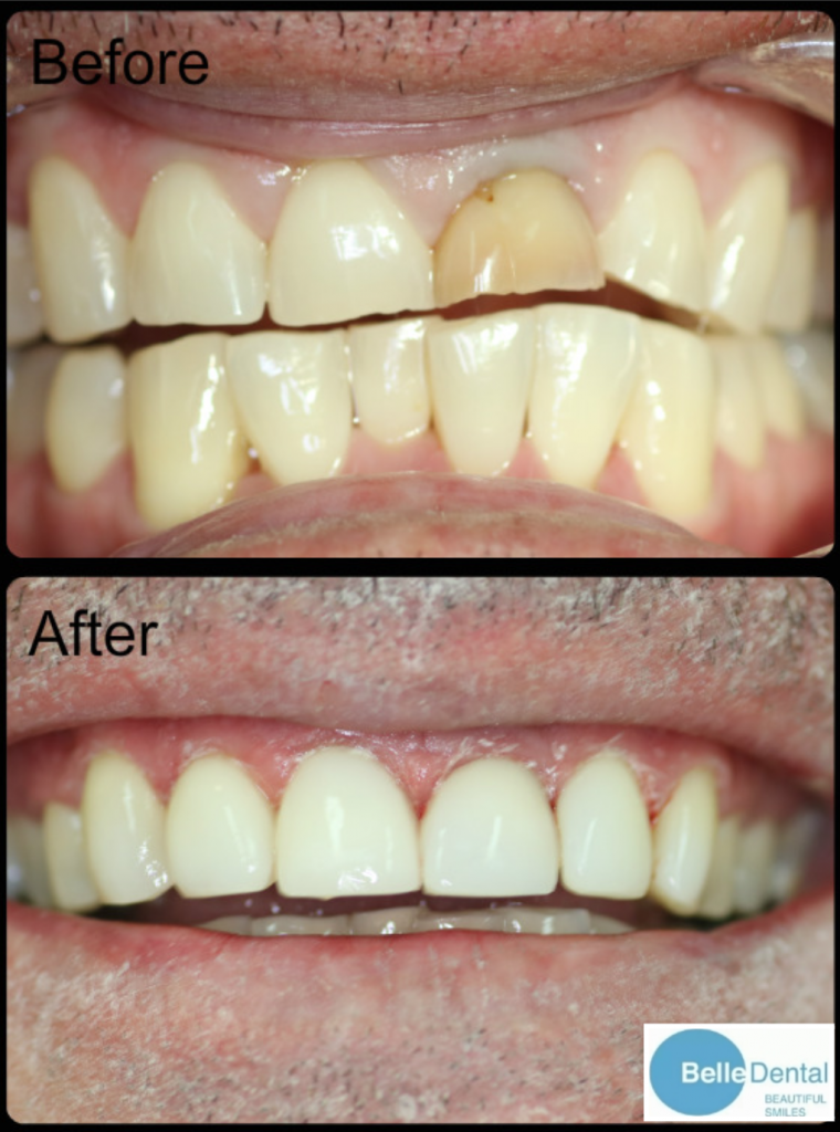 Composite Resin Veneers - BelleDental - June 22, 2018