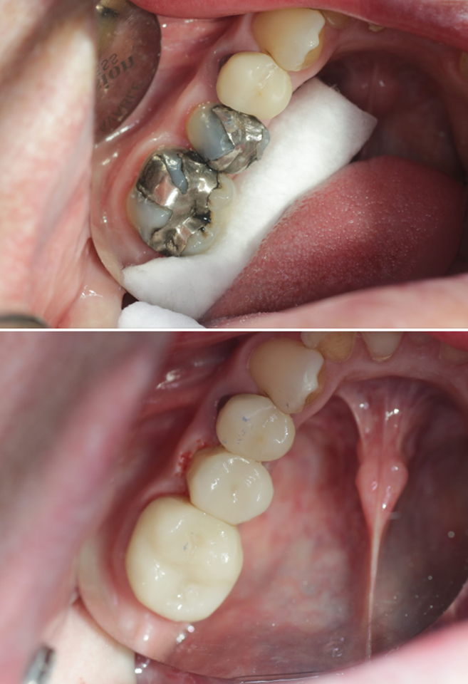 Transformation Tuesday ? - BelleDental - March 19, 2019