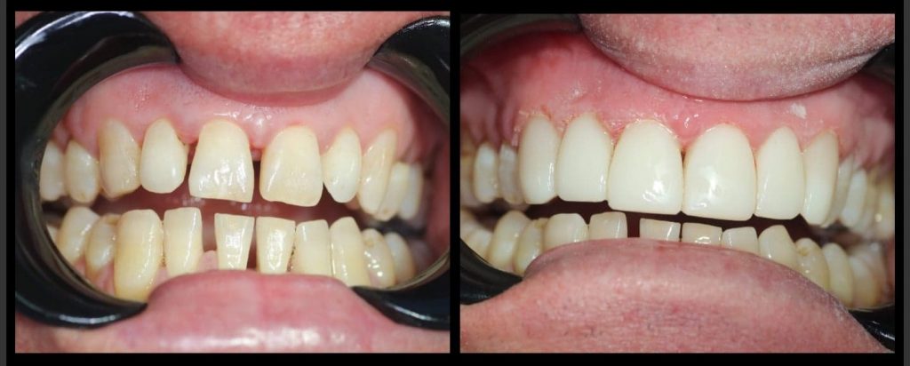 Composite Resin - BelleDental