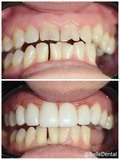 Transformation Tuesday ? - BelleDental - December 17, 2019