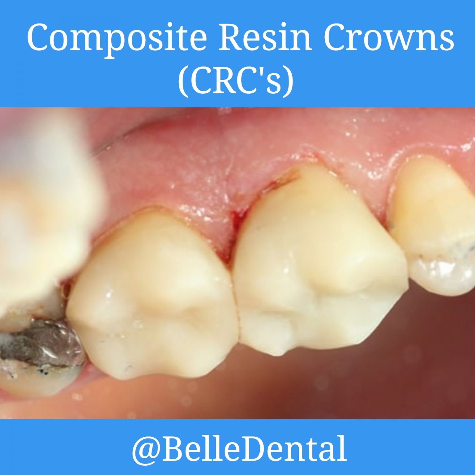 Composite Resin Crowns - BelleDental - July 23, 2020