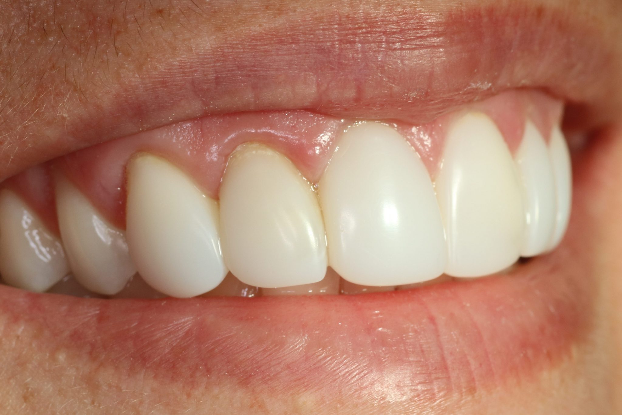 Direct Resin Veneers (Zero Cutting of Tooth) BelleDental