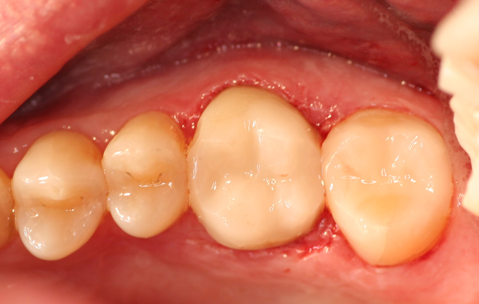 CRCs – Composite Resin Crowns - BelleDental - May 10, 2021